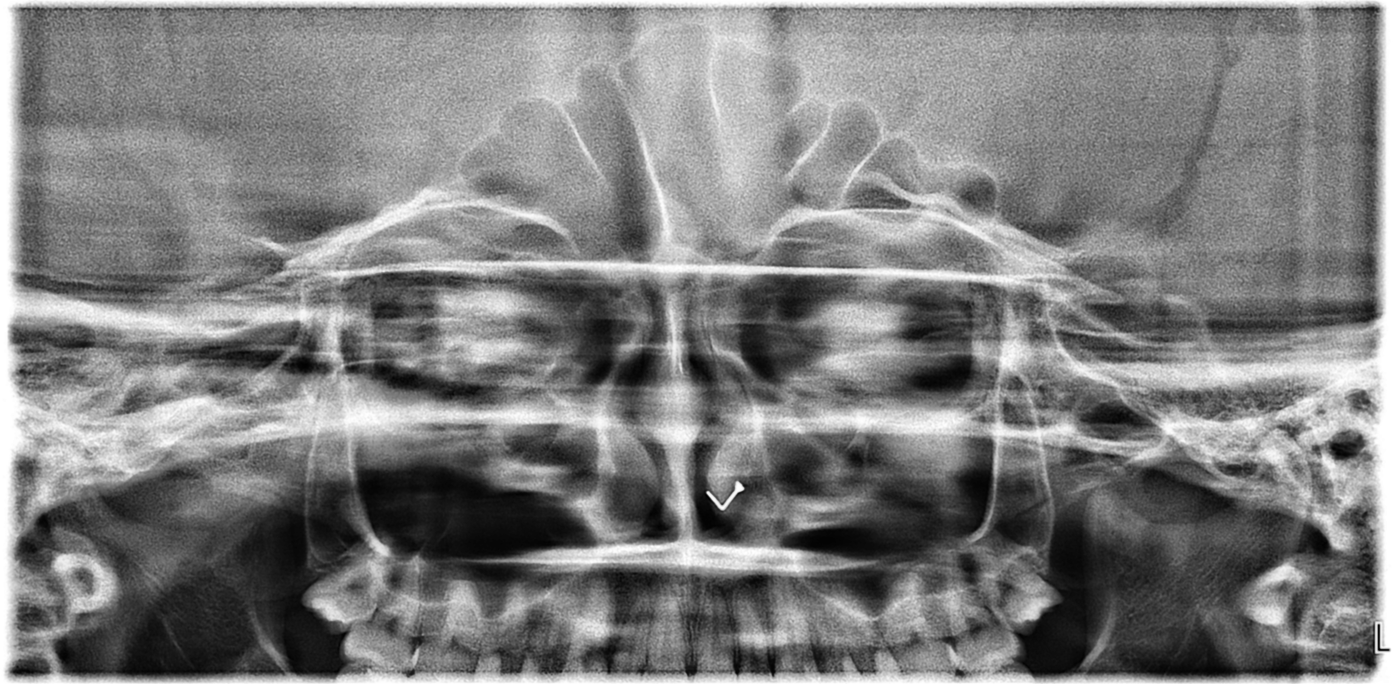 Sinus